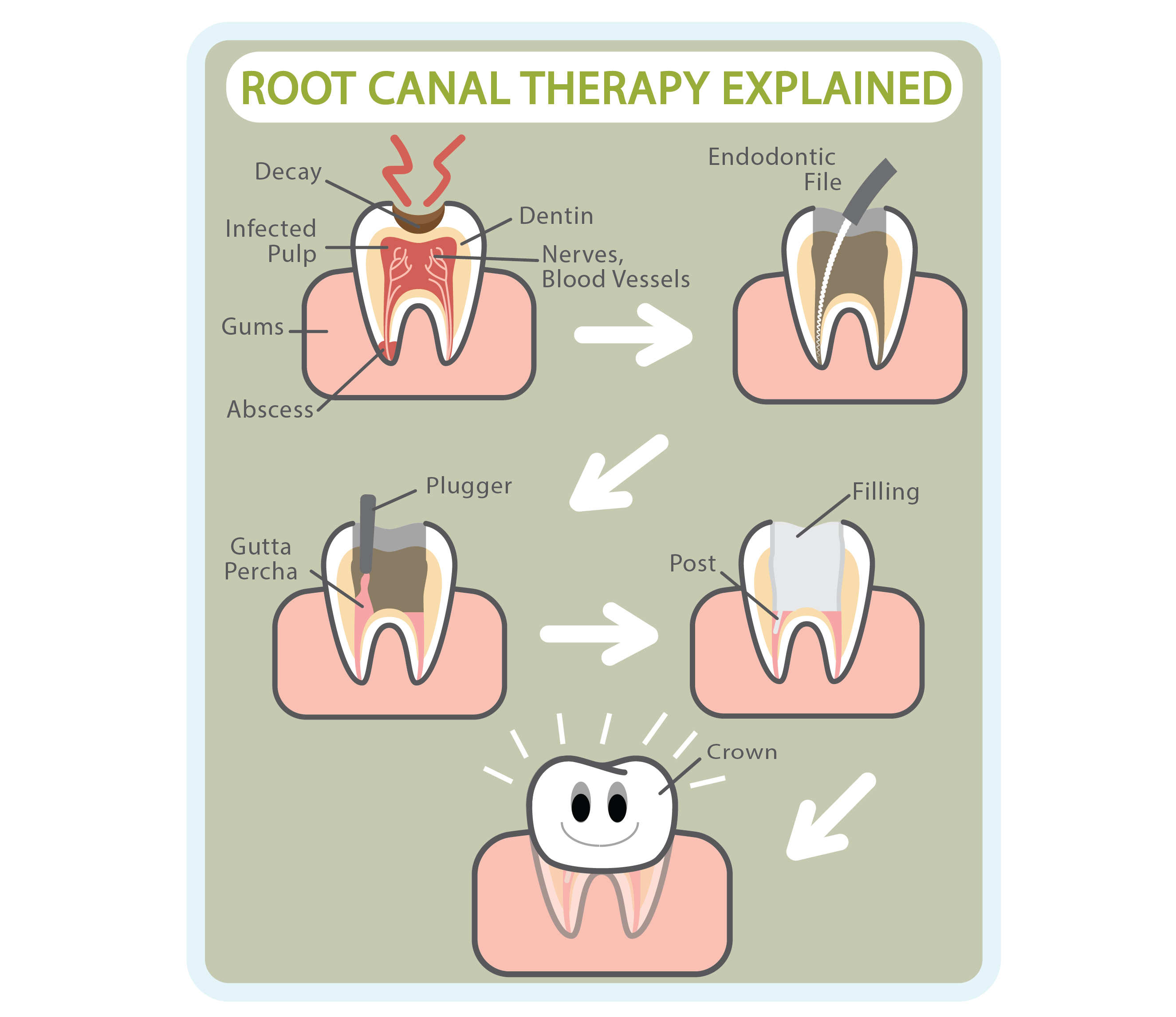 root canal