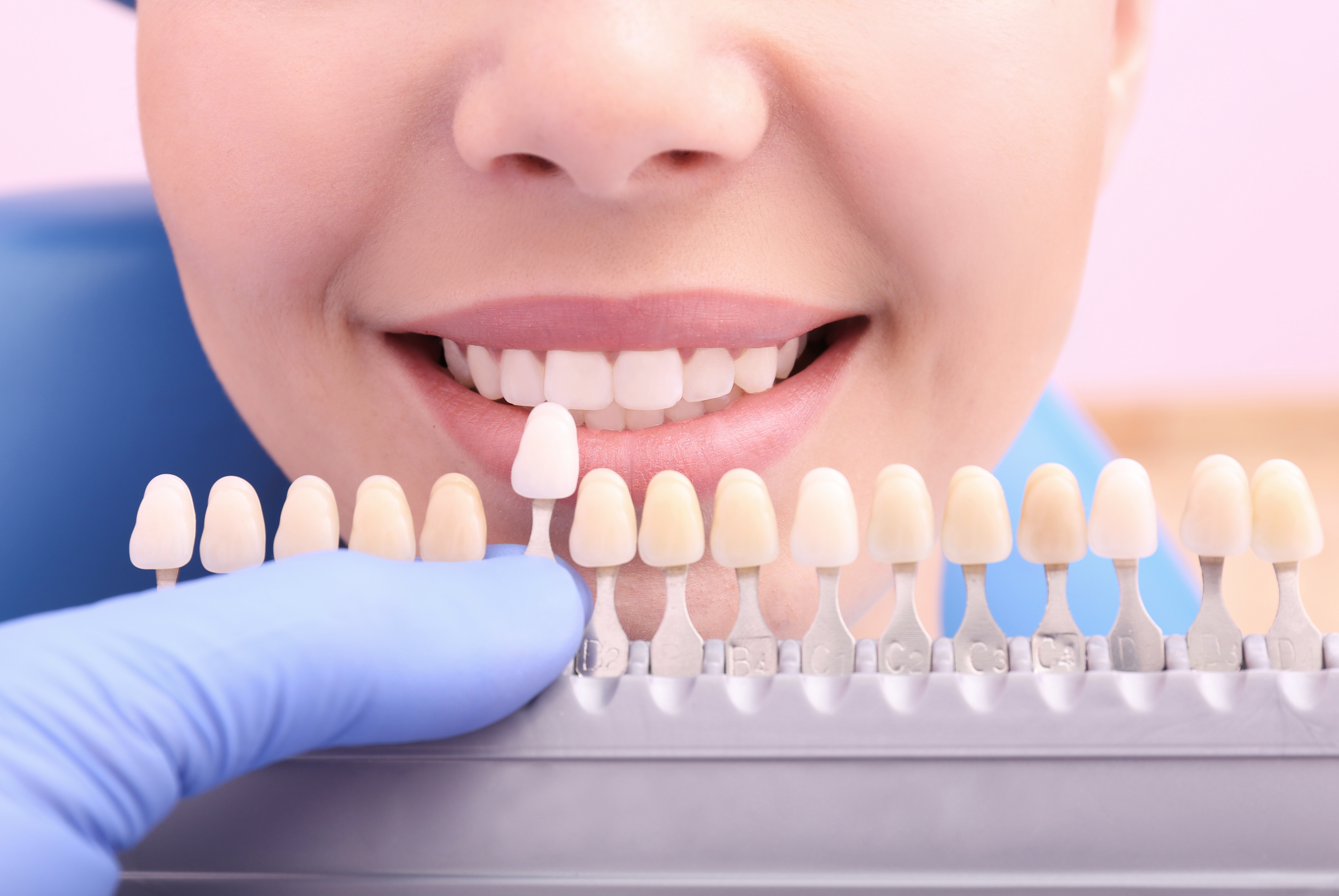 What Is Dental Bonding?