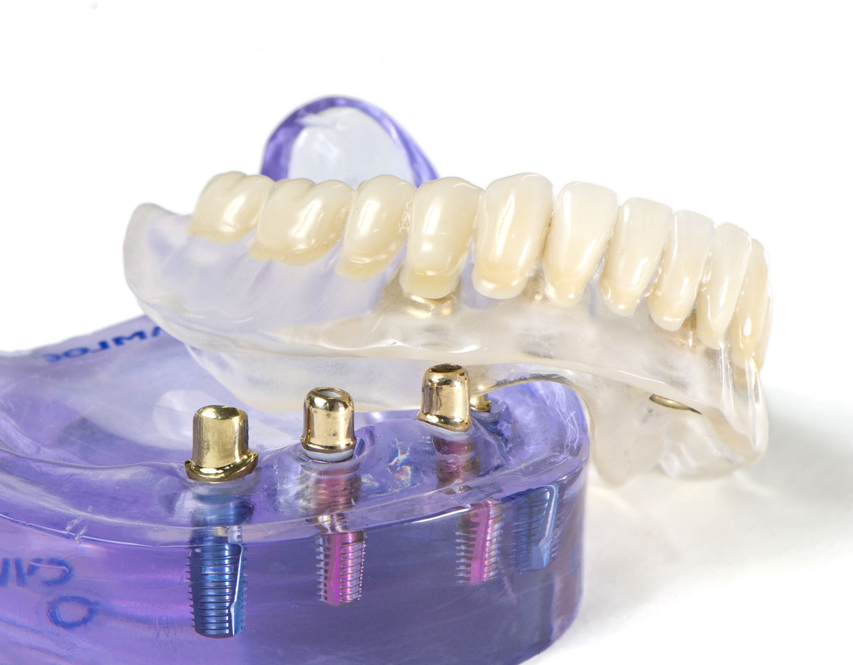 Implant Retained Dentures