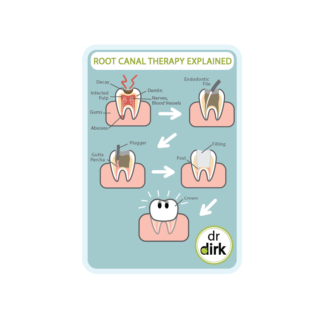 Root Canal Therapy by our General Calgary Dentist